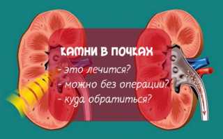 Что такое дистанционная литотрипсия в урологии