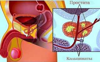 Низкоинтенсивный лазер в урологии лечение камней предстательной железы