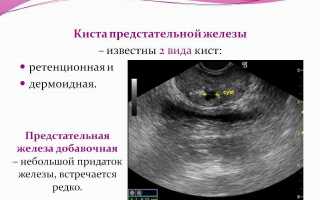 Камни в предстательной железе лечение народными средствами — Врач советует