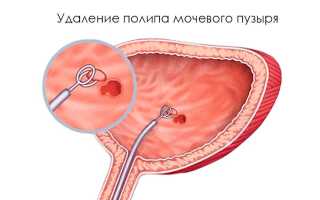 Лечение полипа уретры у женщин и удаление полипов