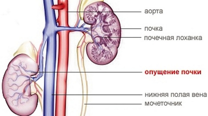 Повышенная подвижность правой почки патологическая