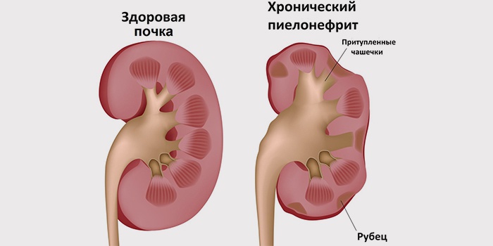 почечная недостаточность и беременность