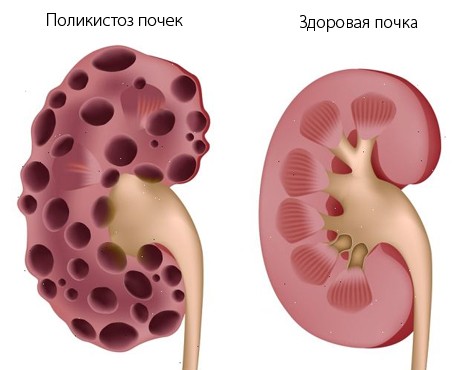 Сравнение здоровой и поликистозной почки